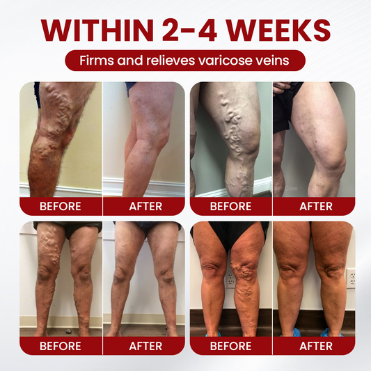 Timlk® Varicose Veins Cream
