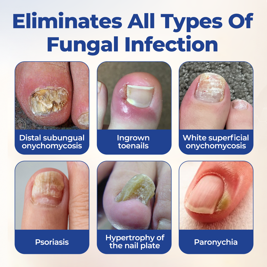 Timlk® FungiBee Advanced Nail Repair Solution