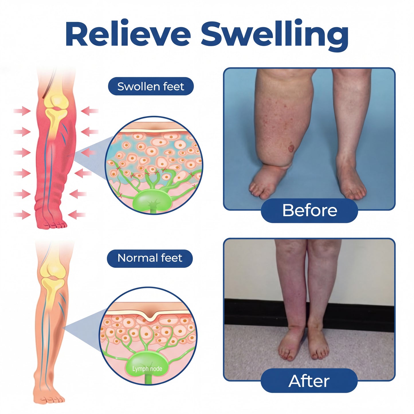 Timlk® Varicose Veins Cream