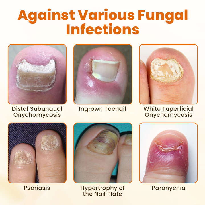 Timlk® FungiBee Advanced Nail Repair Spray
