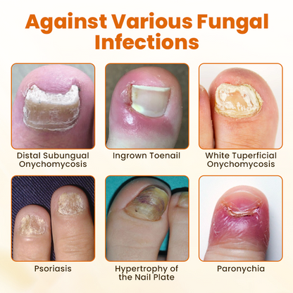 Timlk® FungiBee Advanced Nail Repair Spray