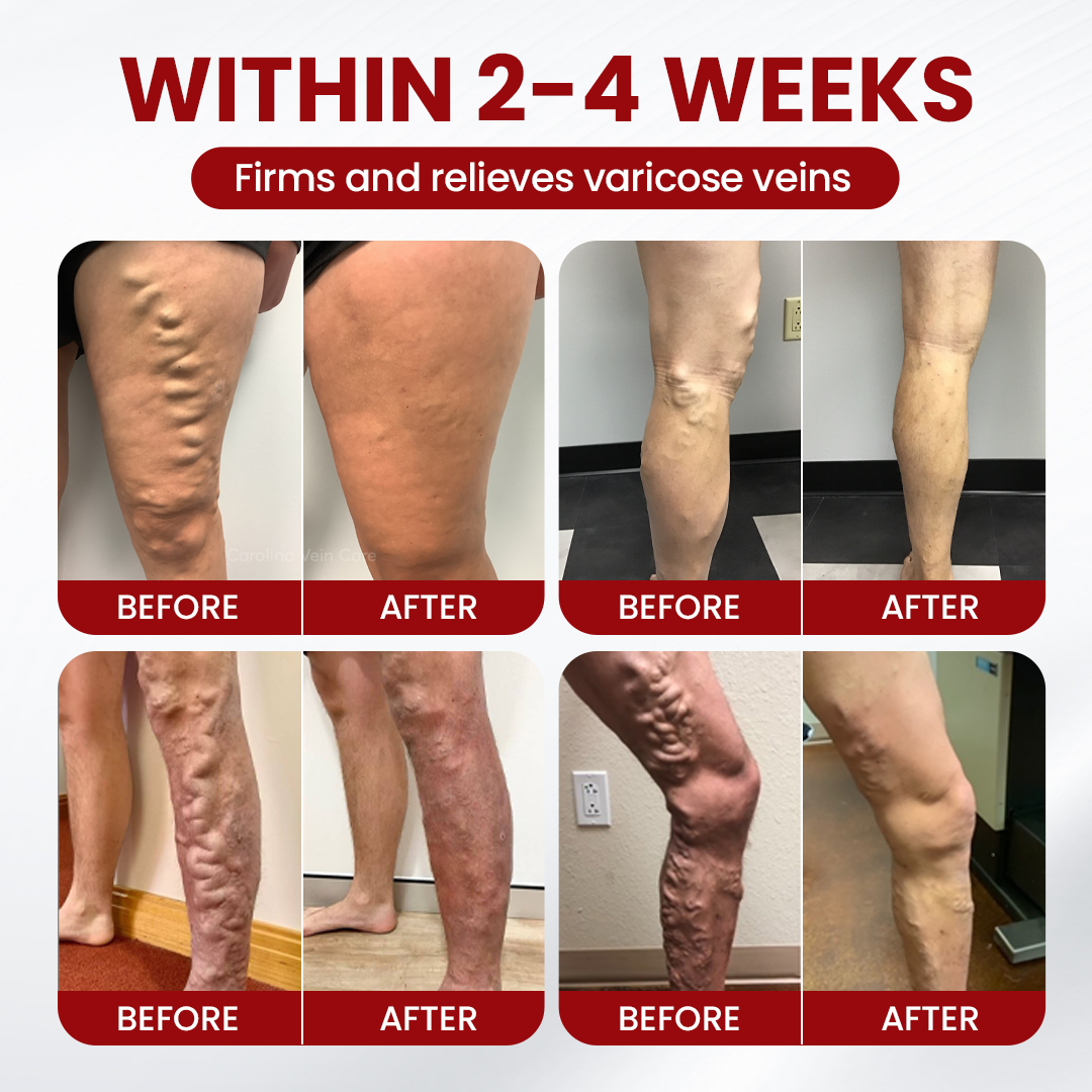 Timlk® Varicose Veins Cream