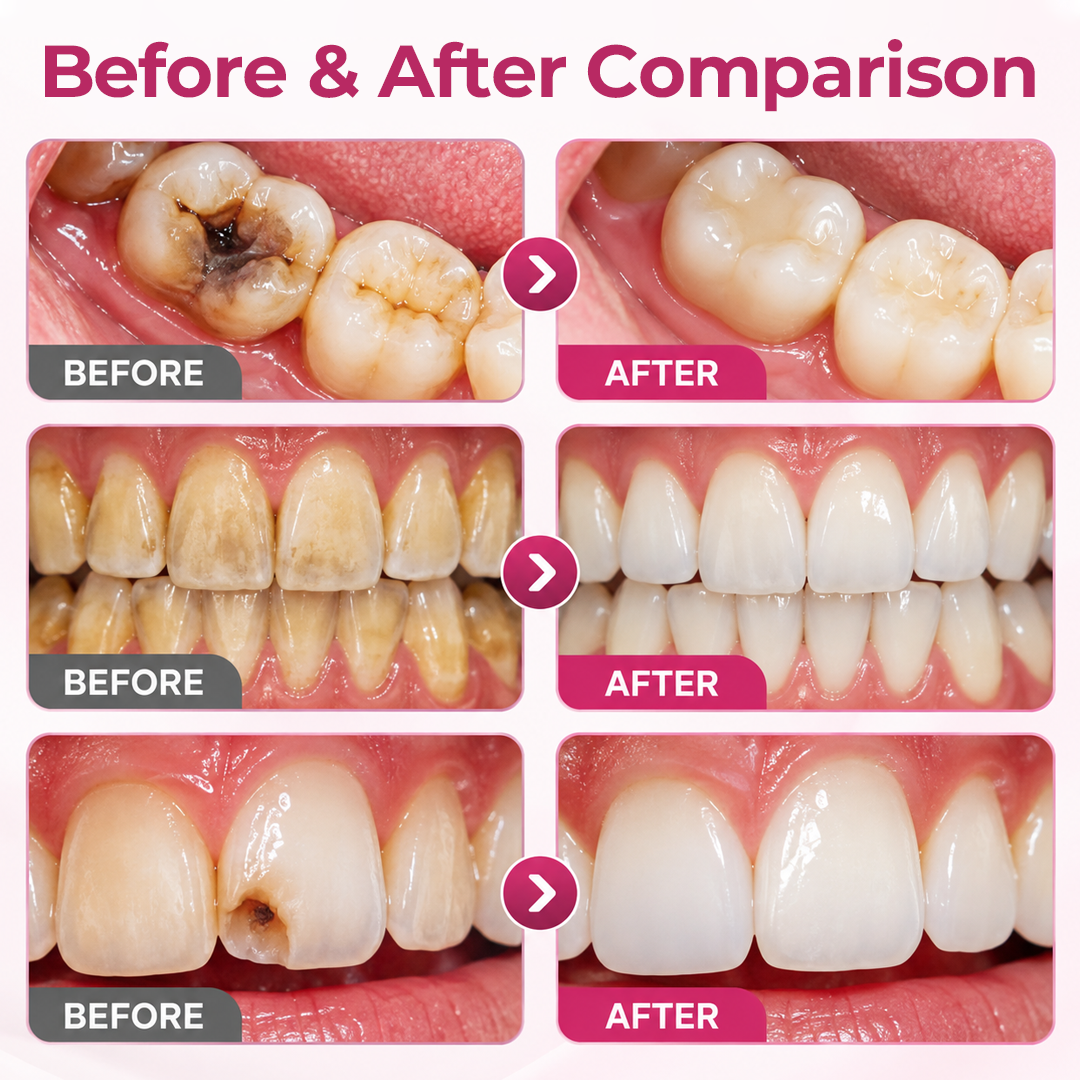 Timlk® DenPerm Cavity-Repair Natural Enamel Filling Gel