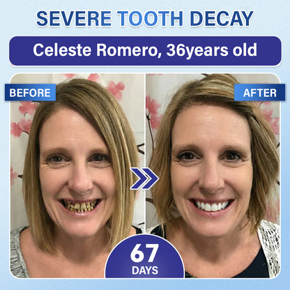 Your Smile🦷Timilk® Tooth & Gum Repair Fast-Dissolving Microneedle Patch✨ (𝟓-𝐢𝐧-𝟏 💎 𝐑𝐞𝐛𝐮𝐢𝐥𝐝 𝐄𝐧𝐚𝐦𝐞𝐥 & 𝐃𝐞𝐧𝐭𝐢𝐧 • 𝐒𝐭𝐫𝐞𝐧𝐠𝐭𝐡𝐞𝐧 𝐆𝐮𝐦𝐬 • 𝐄𝐫𝐚𝐝𝐢𝐜𝐚𝐭𝐞 𝐓𝐚𝐫𝐭𝐚𝐫 & 𝐎𝐝𝐨𝐫 • 𝐖𝐡𝐢𝐭𝐞𝐧𝐢𝐧𝐠 • 𝐒𝐭𝐨𝐩 𝐓𝐨𝐨𝐭𝐡 𝐒𝐞𝐧𝐬𝐢𝐭𝐢𝐯𝐢𝐭𝐲)