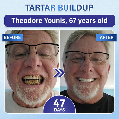 Your Smile🦷Timilk® Tooth & Gum Repair Fast-Dissolving Microneedle Patch✨ (𝟓-𝐢𝐧-𝟏 💎 𝐑𝐞𝐛𝐮𝐢𝐥𝐝 𝐄𝐧𝐚𝐦𝐞𝐥 & 𝐃𝐞𝐧𝐭𝐢𝐧 • 𝐒𝐭𝐫𝐞𝐧𝐠𝐭𝐡𝐞𝐧 𝐆𝐮𝐦𝐬 • 𝐄𝐫𝐚𝐝𝐢𝐜𝐚𝐭𝐞 𝐓𝐚𝐫𝐭𝐚𝐫 & 𝐎𝐝𝐨𝐫 • 𝐖𝐡𝐢𝐭𝐞𝐧𝐢𝐧𝐠 • 𝐒𝐭𝐨𝐩 𝐓𝐨𝐨𝐭𝐡 𝐒𝐞𝐧𝐬𝐢𝐭𝐢𝐯𝐢𝐭𝐲)