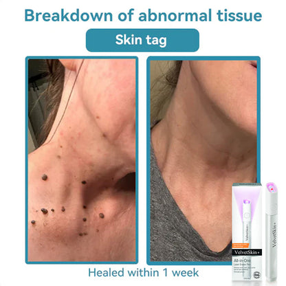 Purekin VelvetSkin+ Medical-Grade Laser Pen (Powered by CO2 laser technology – effectively removes moles, warts, skin tags, pigmentation spots, and other skin imperfections)