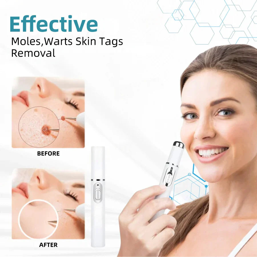 Purekin VelvetSkin+ Medical-Grade Laser Pen (Powered by CO2 laser technology – effectively removes moles, warts, skin tags, pigmentation spots, and other skin imperfections)