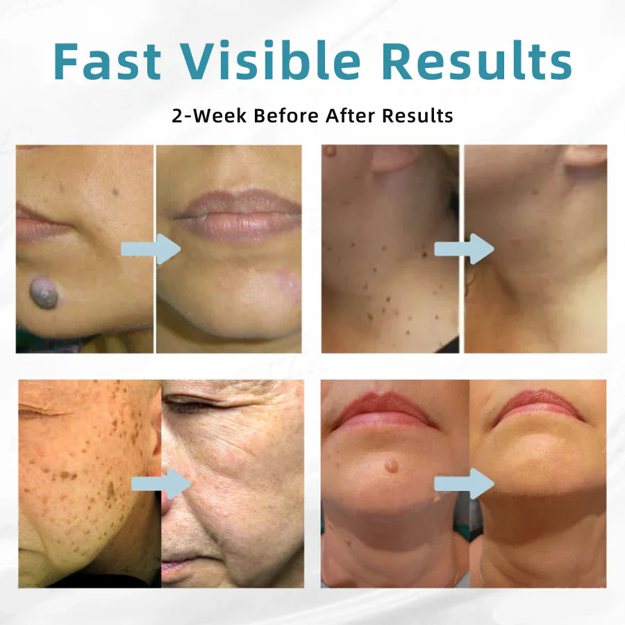 Purekin VelvetSkin+ Medical-Grade Laser Pen (Powered by CO2 laser technology – effectively removes moles, warts, skin tags, pigmentation spots, and other skin imperfections)