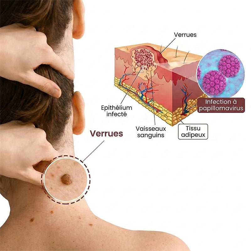 AuraGen® Stylo à double embout pour l'élimination des verrues