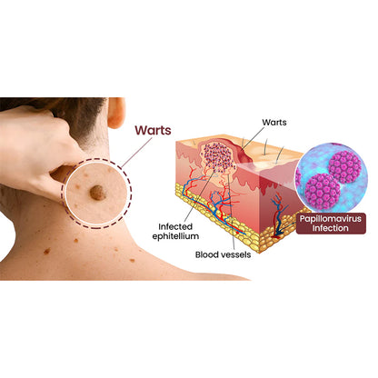 AuraGen® Skin wart removal pen