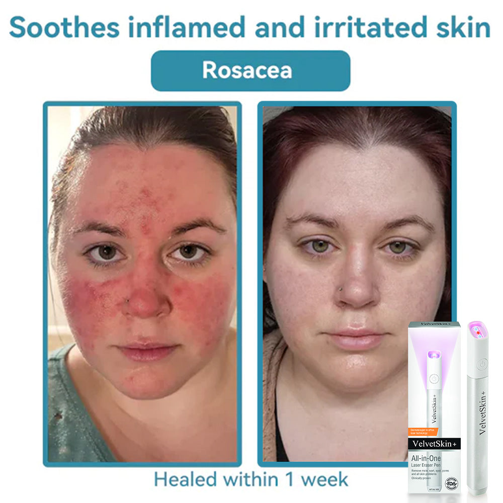 Purekin VelvetSkin+ Medical-Grade Laser Pen (Powered by CO2 laser technology – effectively removes moles, warts, skin tags, pigmentation spots, and other skin imperfections)