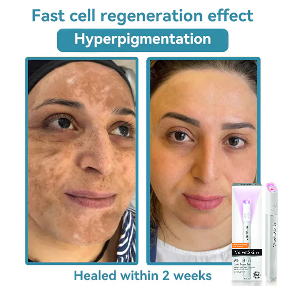 Purekin VelvetSkin+ Medical-Grade Laser Pen (Powered by CO2 laser technology – effectively removes moles, warts, skin tags, pigmentation spots, and other skin imperfections)